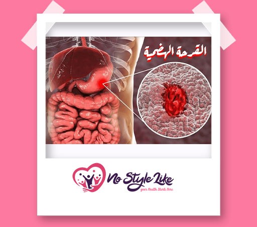 قرحة المعدة Ulcers أسبابها وأعراضها وطرق علاجها