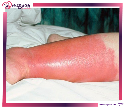 أسباب الحروق Burns