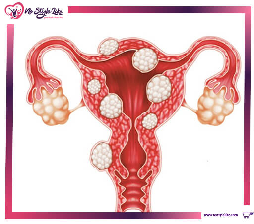 سرطان الرحم Cervical cancer أعراضه ، أسبابه وطرق علاجه